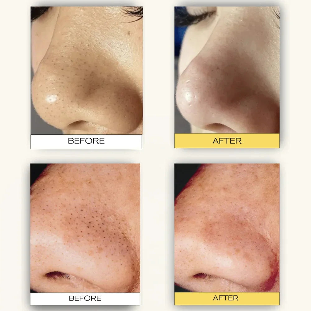 Deep Cleansing Patch System